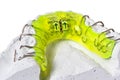 Retainer with plaster cast