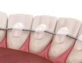 Retainers dental installed after braces treatment, Medically accurate dental 3D illustration Royalty Free Stock Photo