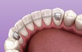 Retainers dental installed after braces treatment, Medically accurate dental 3D illustration Royalty Free Stock Photo