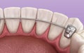 Retainers dental installed after braces treatment, Medically accurate dental 3D illustration