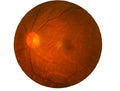 Retina of diabetes , diabates retinopathy,photo Medical Retina Abnormal isolated on white background.Saved with clipping path