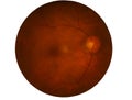 Retina of diabetes , diabates retinopathy,photo Medical Retina Abnormal isolated on white background.Saved with clipping path Royalty Free Stock Photo