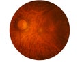 Retina of diabetes , diabates retinopathy,photo Medical Retina Abnormal isolated on white background.Saved with clipping path