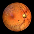 Retina in Ocular Histoplasmosis Syndrome, 3D illustration Royalty Free Stock Photo