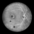 Retina in Ocular Histoplasmosis Syndrome, illustration