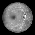 Retina in Ocular Histoplasmosis Syndrome, illustration Royalty Free Stock Photo