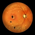 Retina in Ocular Histoplasmosis Syndrome, illustration Royalty Free Stock Photo