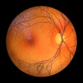 Retinal arteriovenous malformation, 3D illustration