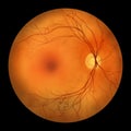 Retinal arteriovenous malformation, illustration Royalty Free Stock Photo