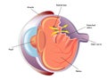 Retinal detachment