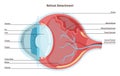 Retinal detachment. Emergency situation in which a thin layer of tissue Royalty Free Stock Photo