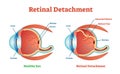 Retinal Detachment vector illustration diagram, anatomical scheme. Royalty Free Stock Photo