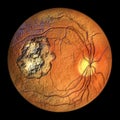 Retinal scar caused by a Toxoplasma gondii infection, or toxoplasmosis, 3D illustration