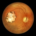 Retinal scar caused by a Toxoplasma gondii infection, or toxoplasmosis, scientific illustration