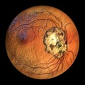 Retinal scar caused by a Toxoplasma gondii infection, or toxoplasmosis, 3D illustration