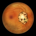 Retinal scar caused by a Toxoplasma gondii infection, or toxoplasmosis, scientific illustration