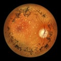 Retinitis pigmentosa, a genetic eye disease leading to vision loss. An illustration shows pigment depositis in the