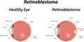 Retinoblastoma