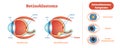 Retinoblastoma vector illustration diagram, anatomical scheme.