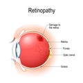 Retinopathy. Vertical section of the eye and eyelids with damage