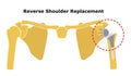 Reverse Shoulder Replacement. Shoulder joint replacement, endoprosthetics. Osteoarthrosis of the shoulder joint. Vector