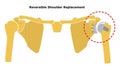 Reversible Shoulder Replacement. Shoulder joint replacement, endoprosthetics. Osteoarthrosis of the shoulder joint. Vector