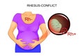 RH-conflict pregnant