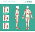 Rheumatism or rheumatic disorder medical posters. Arthritis joint pain. Rheumatology vector infographics Royalty Free Stock Photo