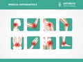 Rheumatism or rheumatic disorder medical set. Arthritis joint pain. Rheumatology vector infographics