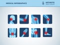 Rheumatism or rheumatic disorder medical set. Arthritis joint pain. Rheumatology vector infographics Royalty Free Stock Photo