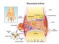 Rheumatoid Arthritis