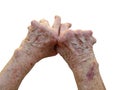 Rheumatoid Arthritis