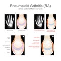 Rheumatoid Arthritis.