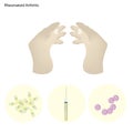 Rheumatoid Arthritis of Finger Joint with Disease Treatment