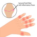 Rheumatoid arthritis on fingers medical vector illustration