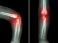 Rheumatoid arthritis , Gouty arthritis ( film x-ray child's elbow with arthritis at elbow ) ( Side and front view , Lateral and A Royalty Free Stock Photo