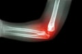 Rheumatoid arthritis , Gouty arthritis ( film x-ray child's elbow with arthritis at elbow ) ( Side view , Lateral ) Royalty Free Stock Photo