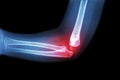 Rheumatoid arthritis , Gouty arthritis ( film x-ray child's elbow with arthritis at elbow ) ( Side view , Lateral )