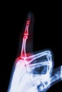 Rheumatoid arthritis , Gouty arthritis Royalty Free Stock Photo