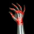 Rheumatoid Arthritis , Gouty Arthritis Royalty Free Stock Photo