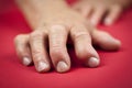 Rheumatoid arthritis hand Royalty Free Stock Photo