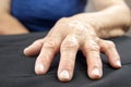 Rheumatoid Arthritis hand Royalty Free Stock Photo