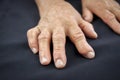 Rheumatoid arthritis hand Royalty Free Stock Photo