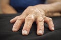 Rheumatoid arthritis hand Royalty Free Stock Photo