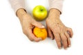 Rheumatoid arthritis hands and fruits Royalty Free Stock Photo