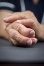 Rheumatoid arthritis hands Royalty Free Stock Photo