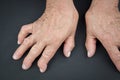 Rheumatoid arthritis hands Royalty Free Stock Photo