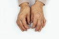 Rheumatoid arthritis hands Royalty Free Stock Photo