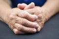 Rheumatoid Arthritis hands Royalty Free Stock Photo