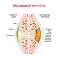 Rheumatoid arthritis. Healthy and damage joint